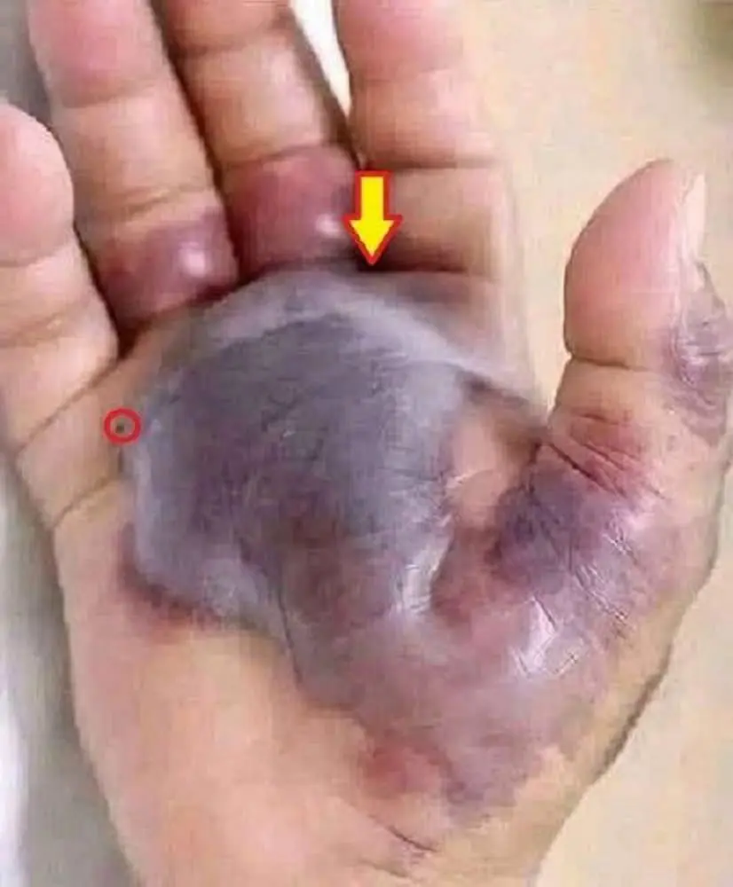 ATTENTION to These First Signs of Infection: Why Doctors Warn That Even a Small Cut or Insect Bite Needs Care