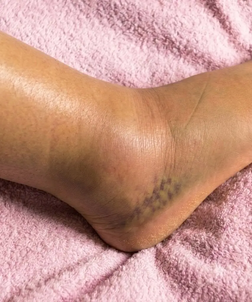 Swollen Legs: What Could It Mean? Common Causes You Should Never Ignore