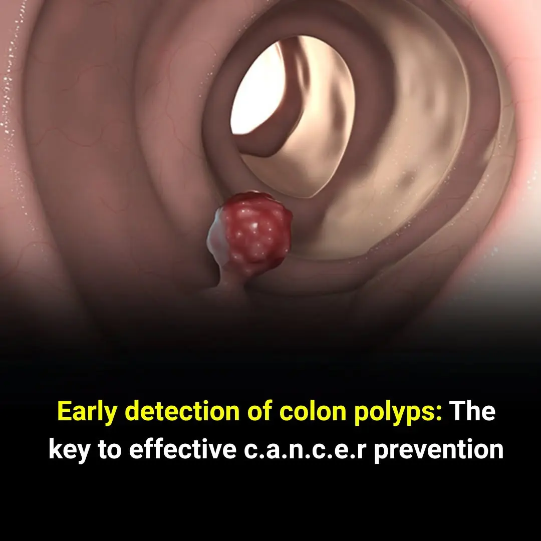 Don't Ignore Colon Polyps—Early Detection Can Save Lives