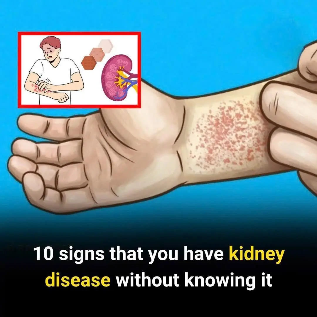 10 Ways Your Body Warns You About Kidney Disease