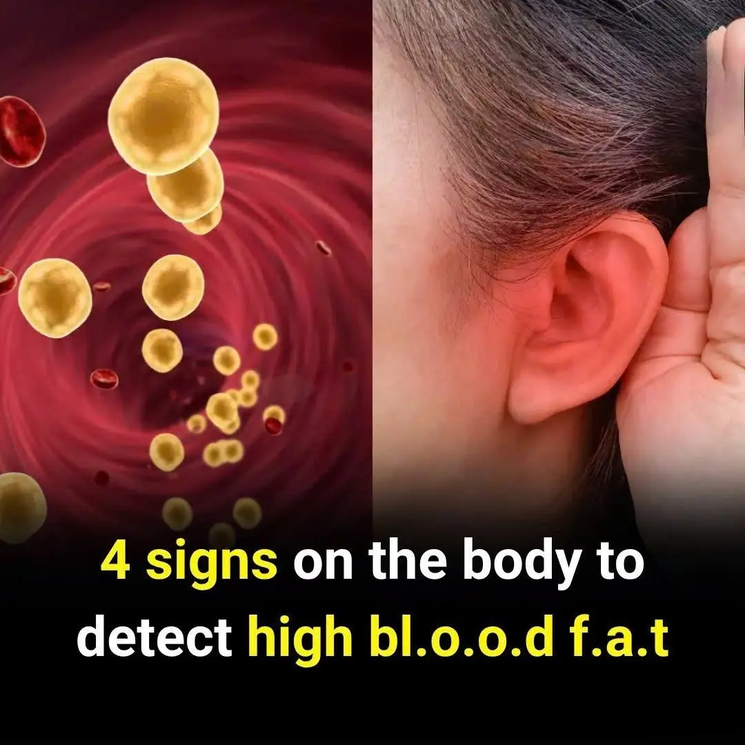 4 Subtle Clues on Your Body That Point to High Blo.o.d Fa.t