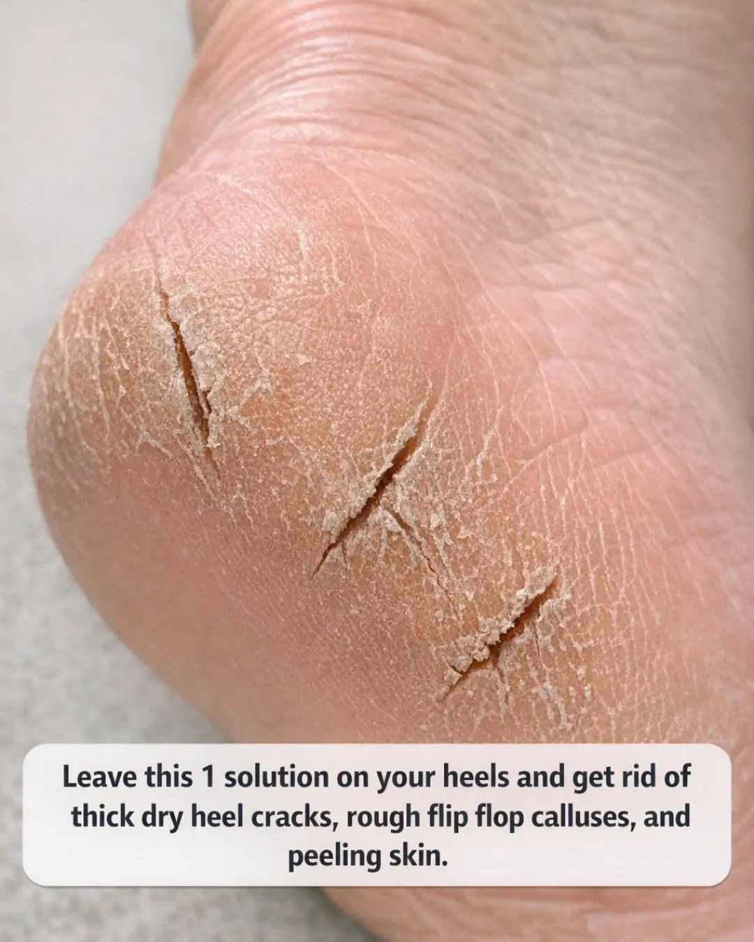 Leave this 1 solution on your heels and get rid of thick dry heel cracks, rough flip flop calluses, and peeling skin.