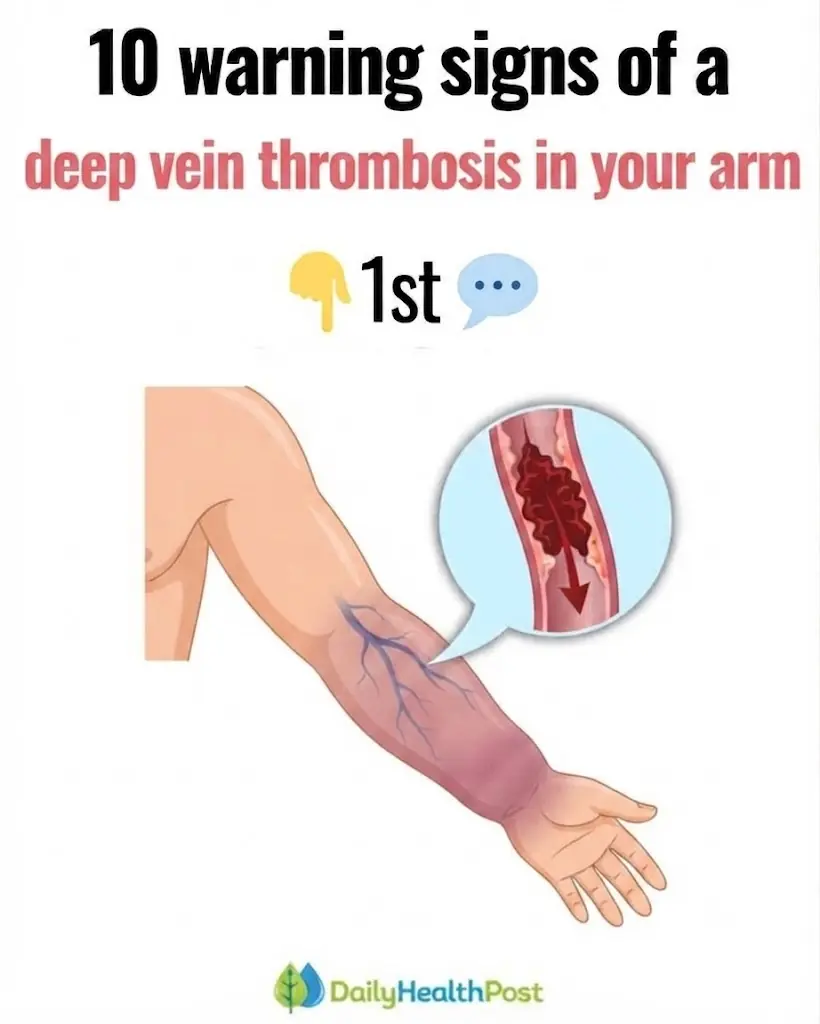 Top 10 signs of a BLOOD CLOT in your leg (prevent Deep Vein Thrombosis)