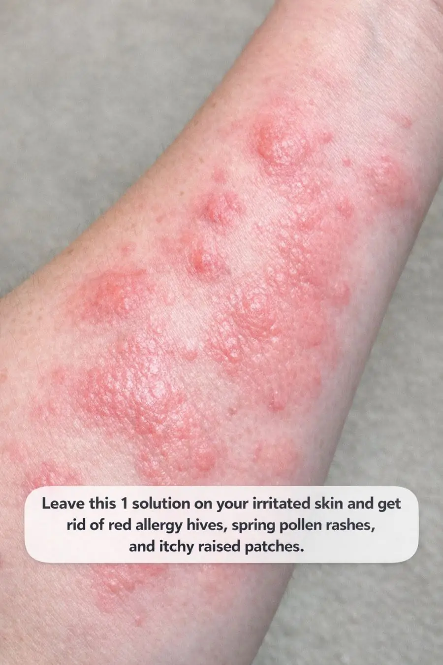 Leave this 1 solution on your irritated skin and get rid of red allergy hives, spring pollen rashes, and itchy raised patches.