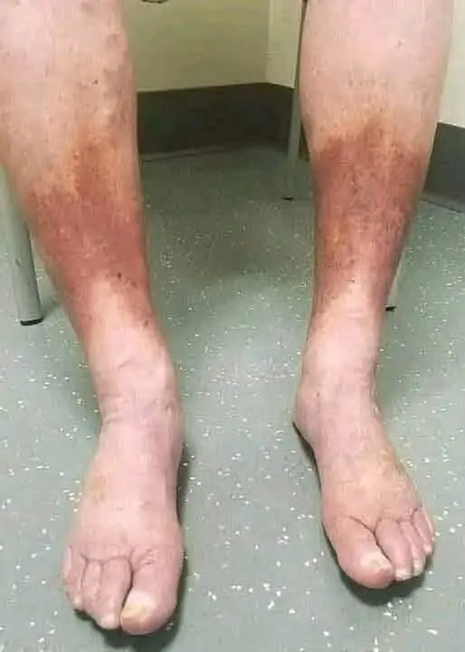 Swollen Feet and Ankles: 10 Possible Causes, Warning Signs, and When to See a Doctor