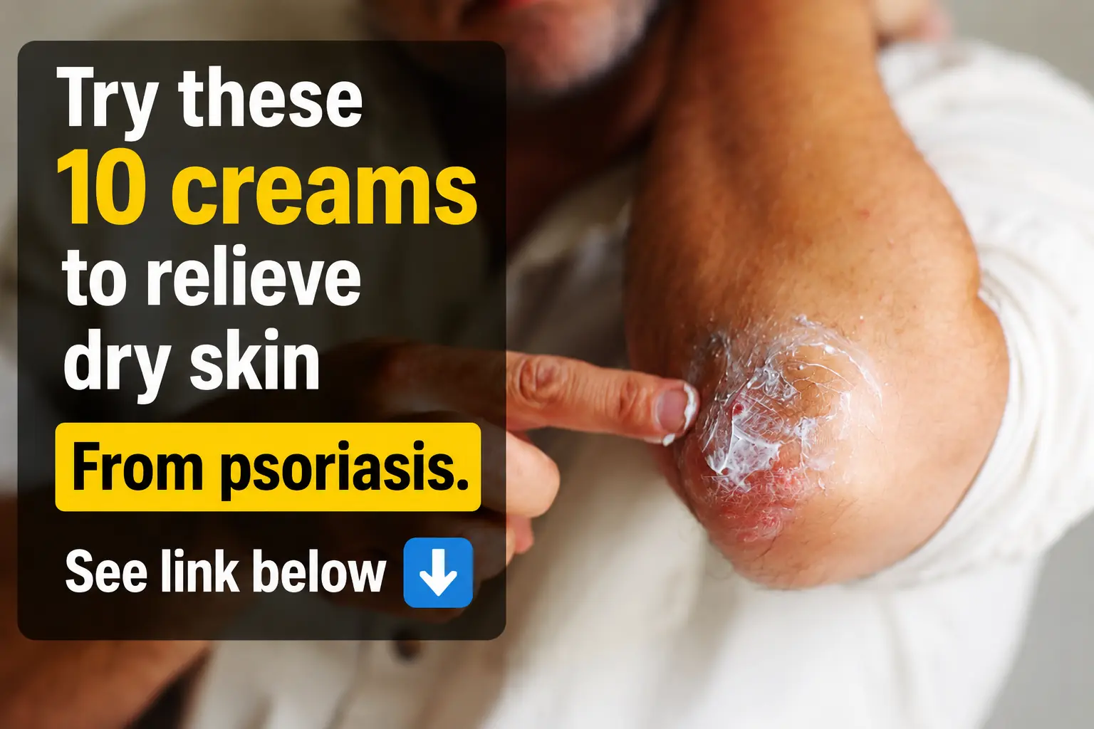 10 Creams That Can Relieve Your Psoriasis