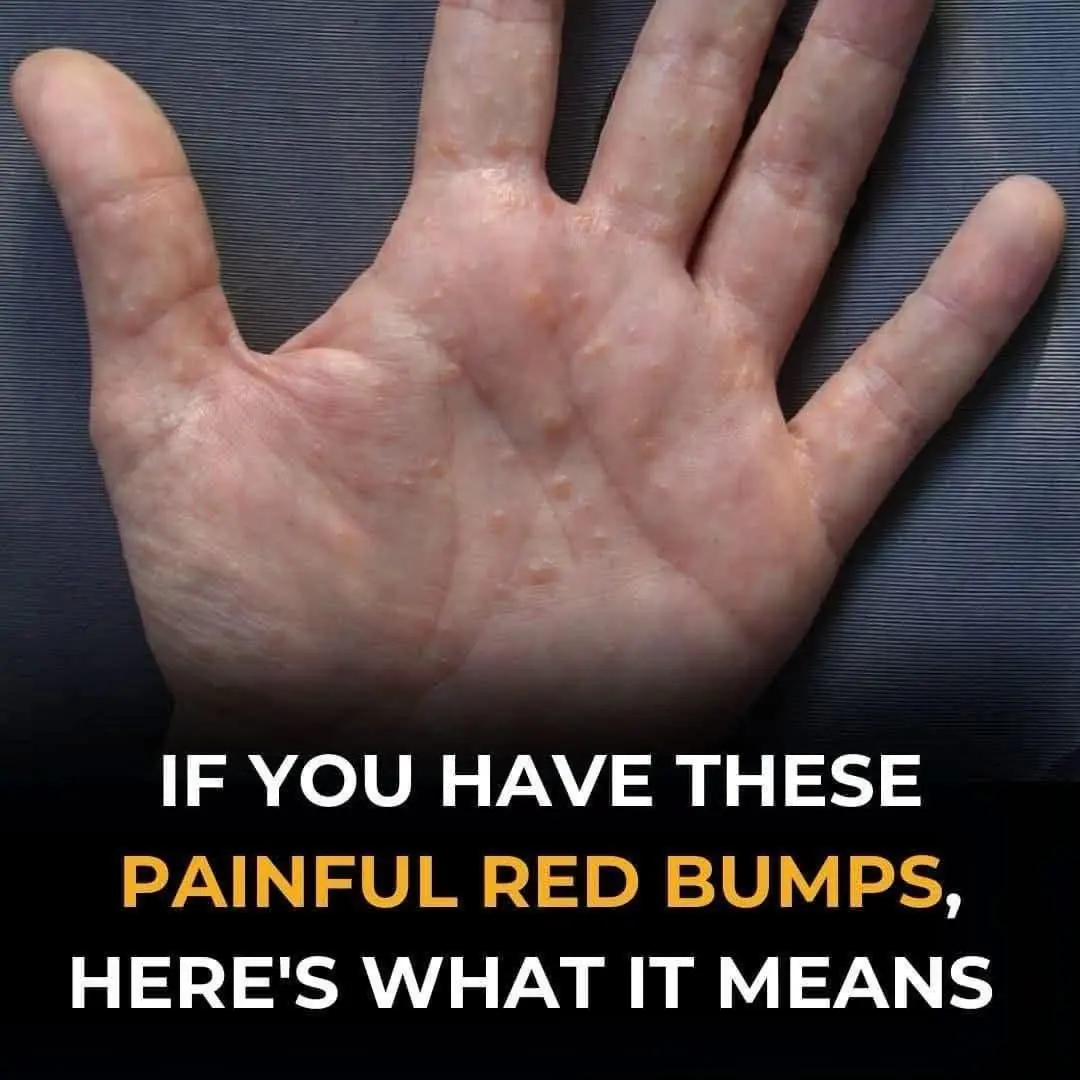 Painful Red Bumps on Skin? It Might Be Dyshidrotic Eczema