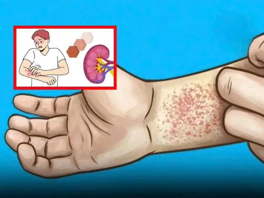 10 Ways Your Body Warns You About Kidney Disease (But You Don’t Notice)