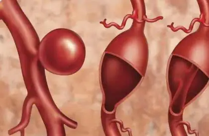 The Silent Danger of Aneurysms: Symptoms to Be Aware Of