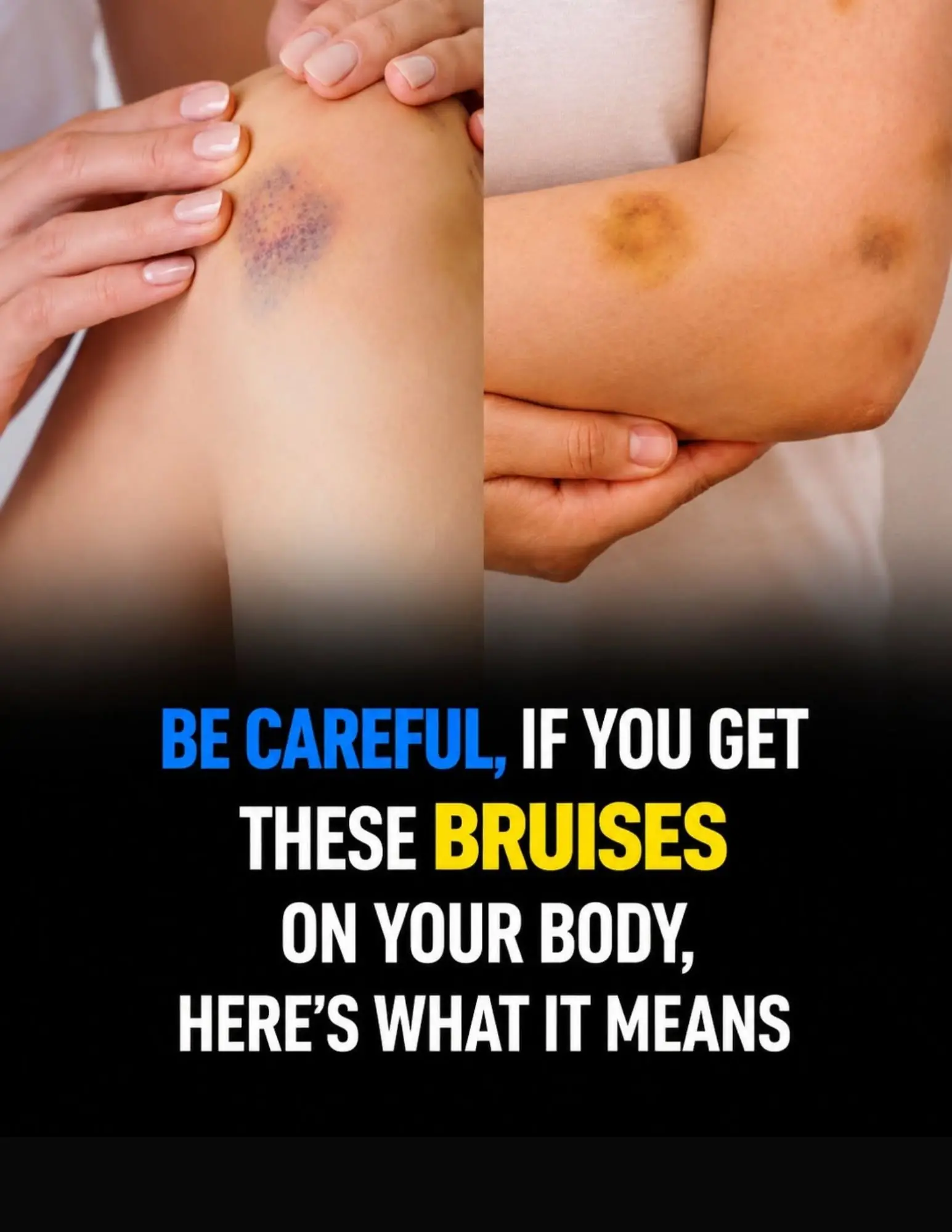 Bruising Easily? Here's What Frequent Bruises Could Be Trying to Tell You