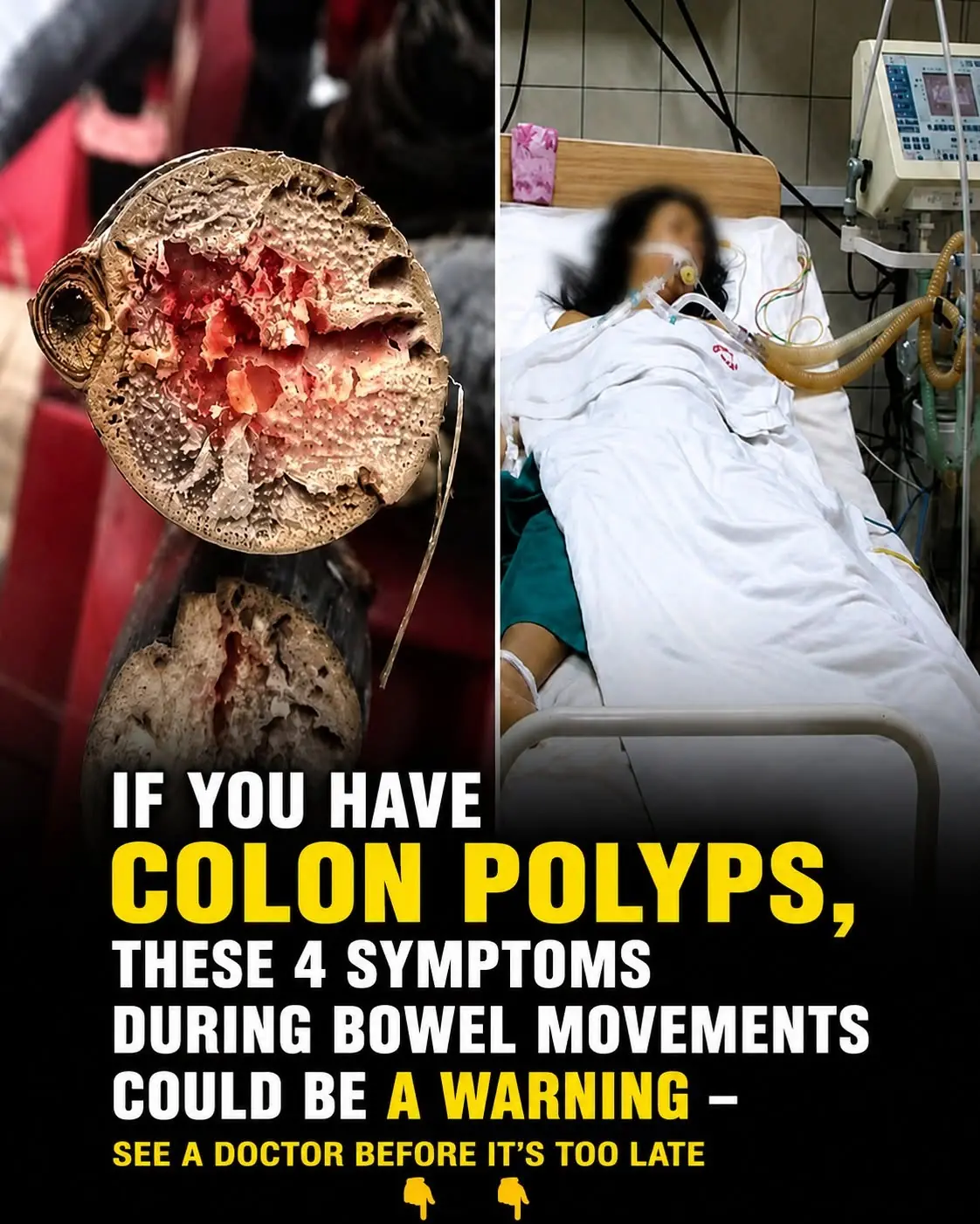 If You Have Colon Polyps, These 4 Symptoms During Bowel Movements Could Be a Warning — See a Doctor Before It's Too Late