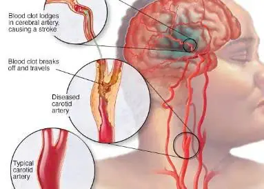 Your Body May Give You Early Clues—These 6 Nighttime Symptoms Could Be Important