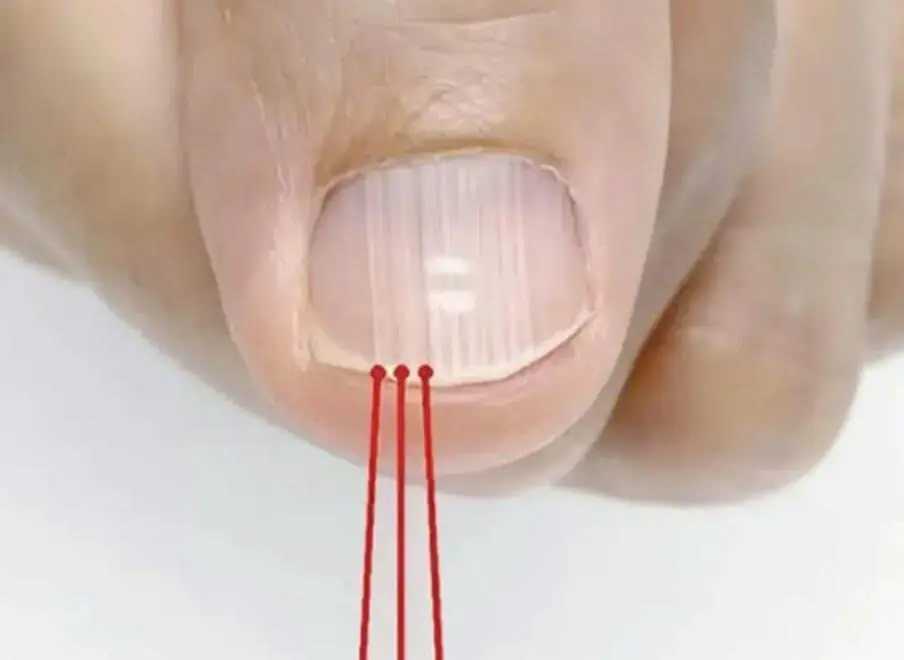 Over 40? Lines on Your Nails May Reveal More Than You Think