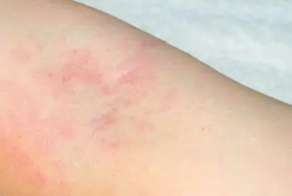 He Ignored What Looked Like an Allergy - Until Doctors Found the Real Cause