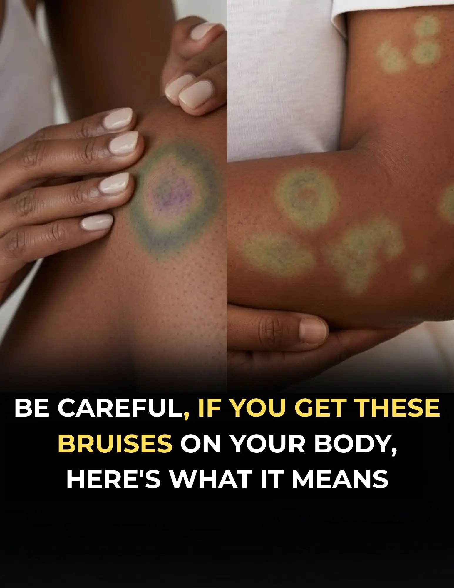 Not All Bruises Are the Same—Here's When They May Be Worth Checking
