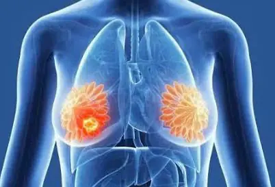 Early Detection Matters: 10 Breast Cancer Symptoms Everyone Should Know