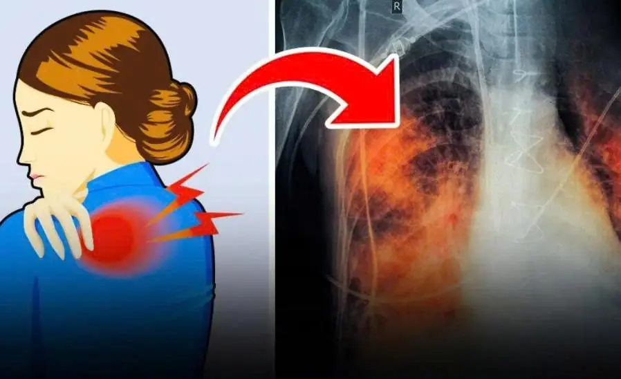 These 3 types of pai.n may indicate lung can.cer. Don’t overlook them