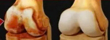 97-Year-Old Orthopedic Doctor Says: This 1 Food Can Rebuild Knee Cartilage in Just 24 Hours