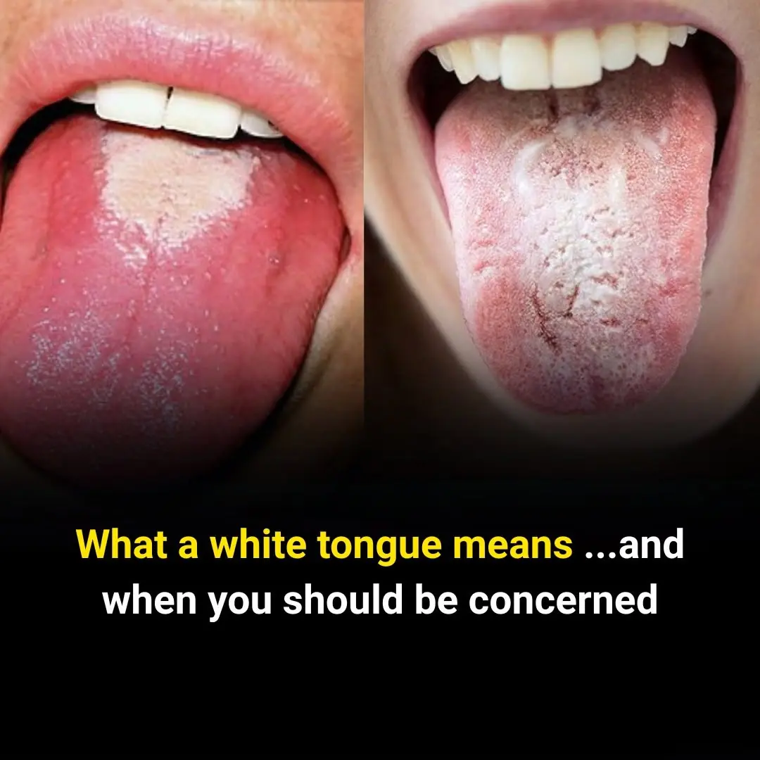 A White Tongue May Be Telling You More About Your Health Than You Think