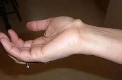 What a Small Wrist Bump May Mean: Understanding Ganglion Cysts