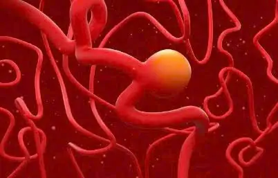 Symptoms That May Indicate an Aneu.rysm