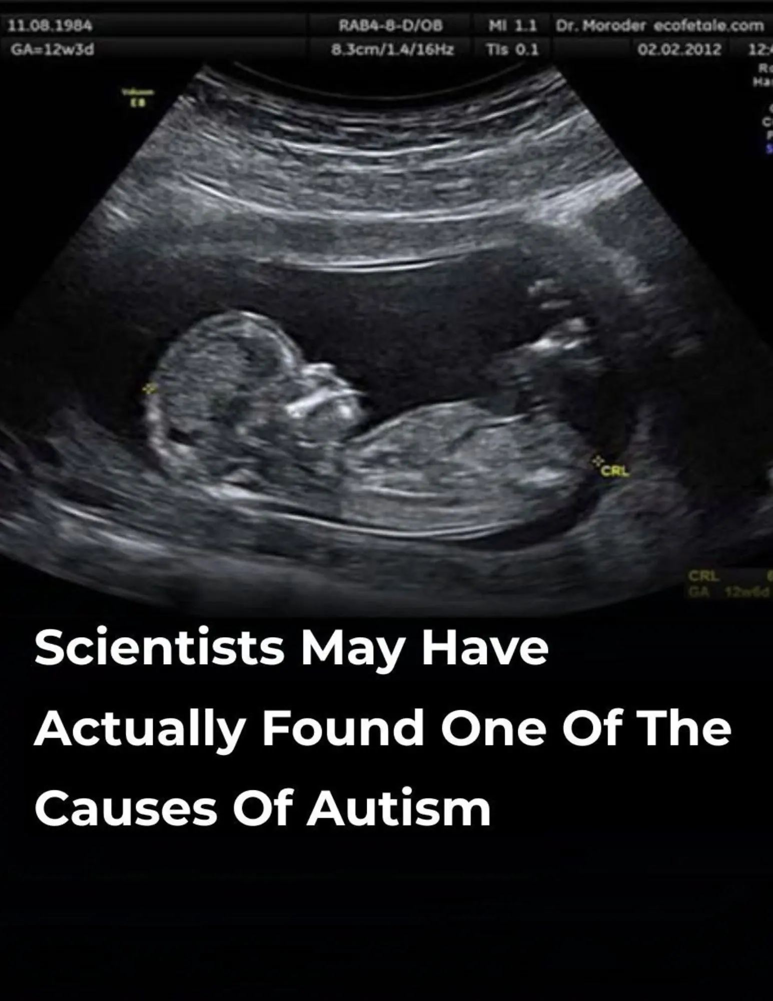 Scientists May Have Actually Found One Of The Causes Of Autism