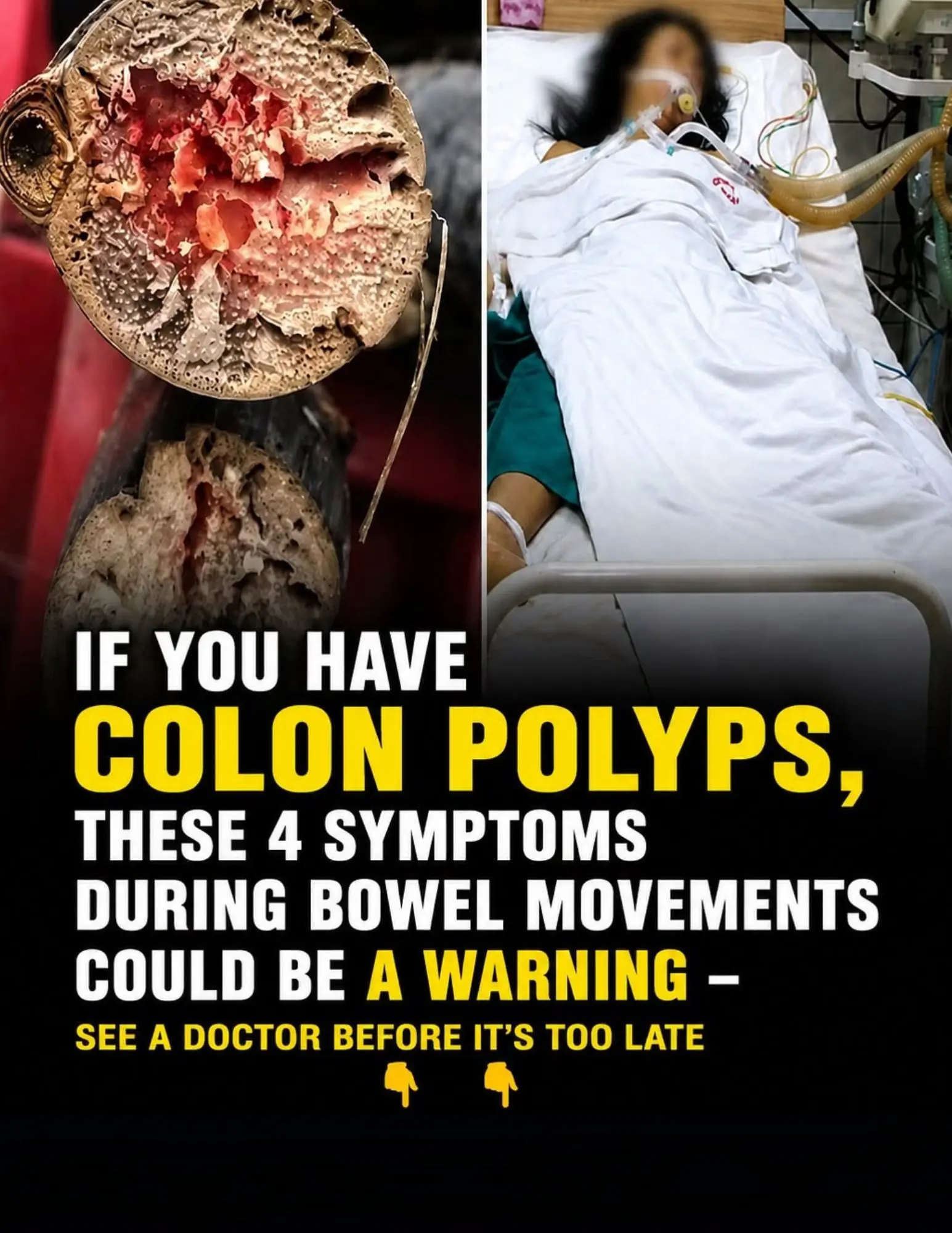 If You Have Colon Polyps, These 4 Symptoms During Bowel Movements Could Be a Warning — See a Doctor Before It's Too Late