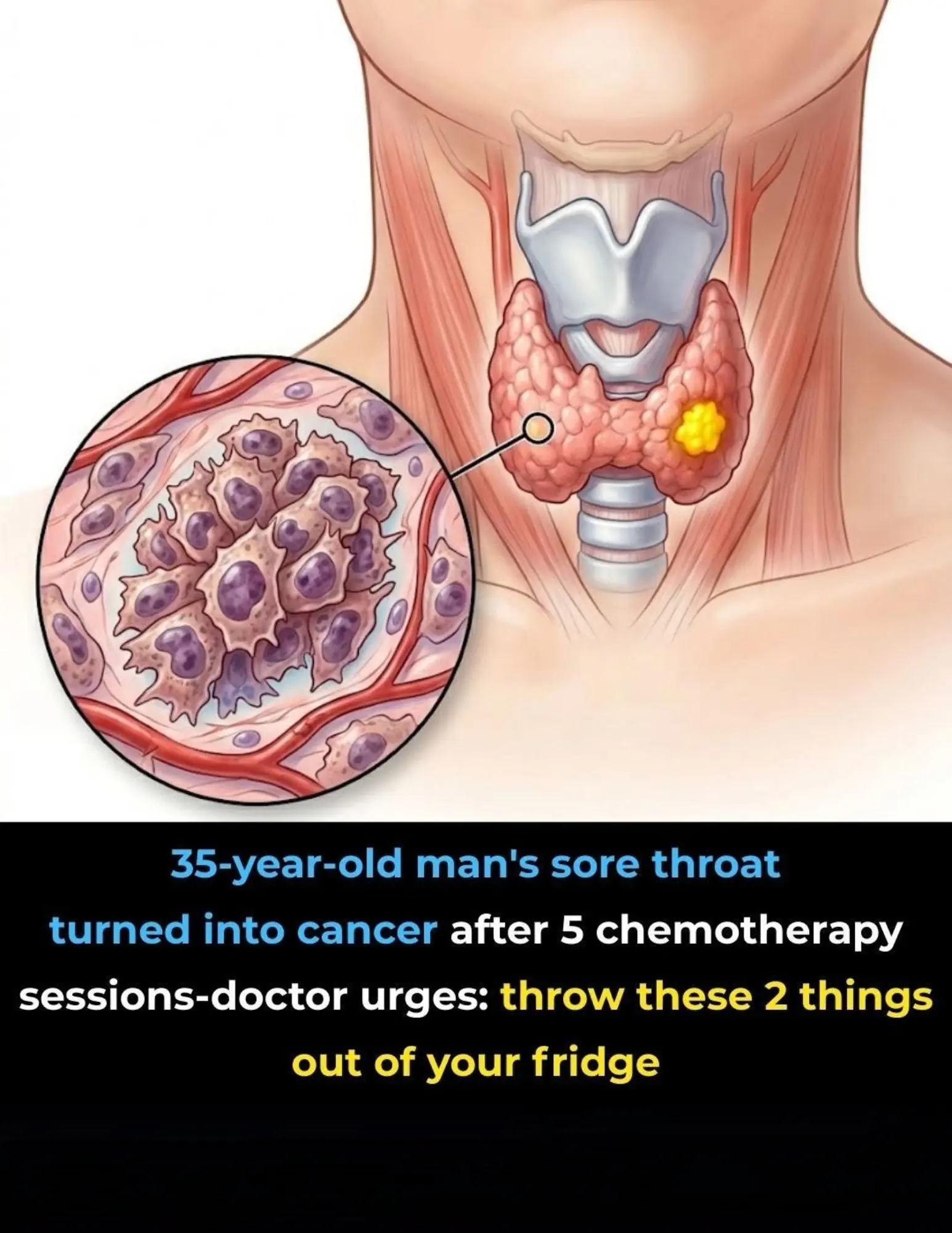 What Started as a Simple Sore Throat Became Cancer After 5 Chemotherapy Sessions