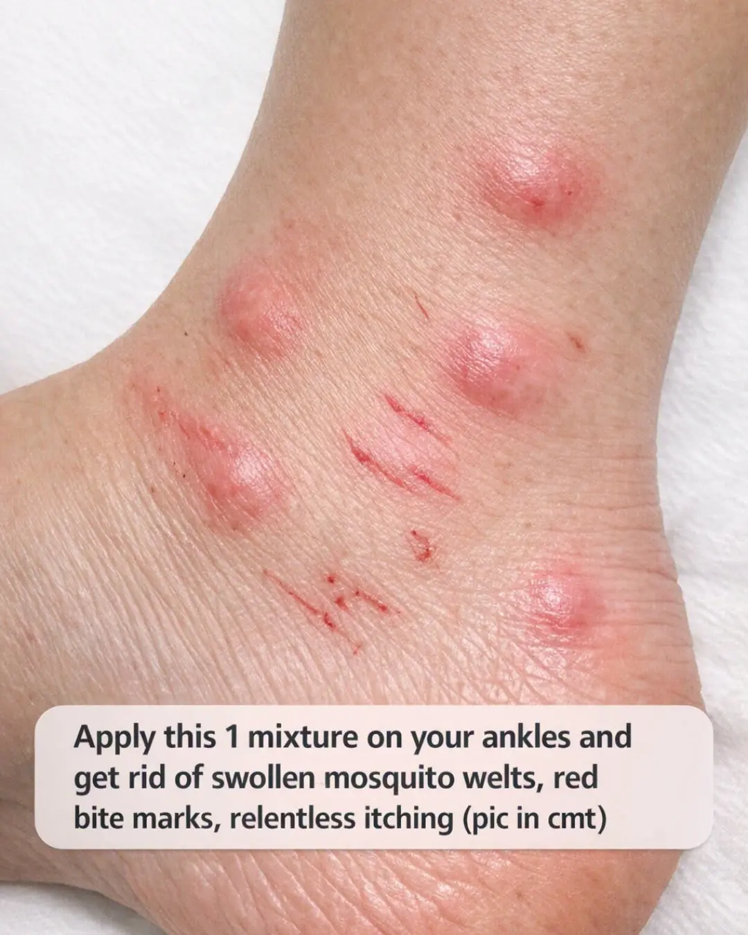 Apply this 1 mixture on your ankles and get rid of swollen mosquito welts, red bite marks, relentless itching