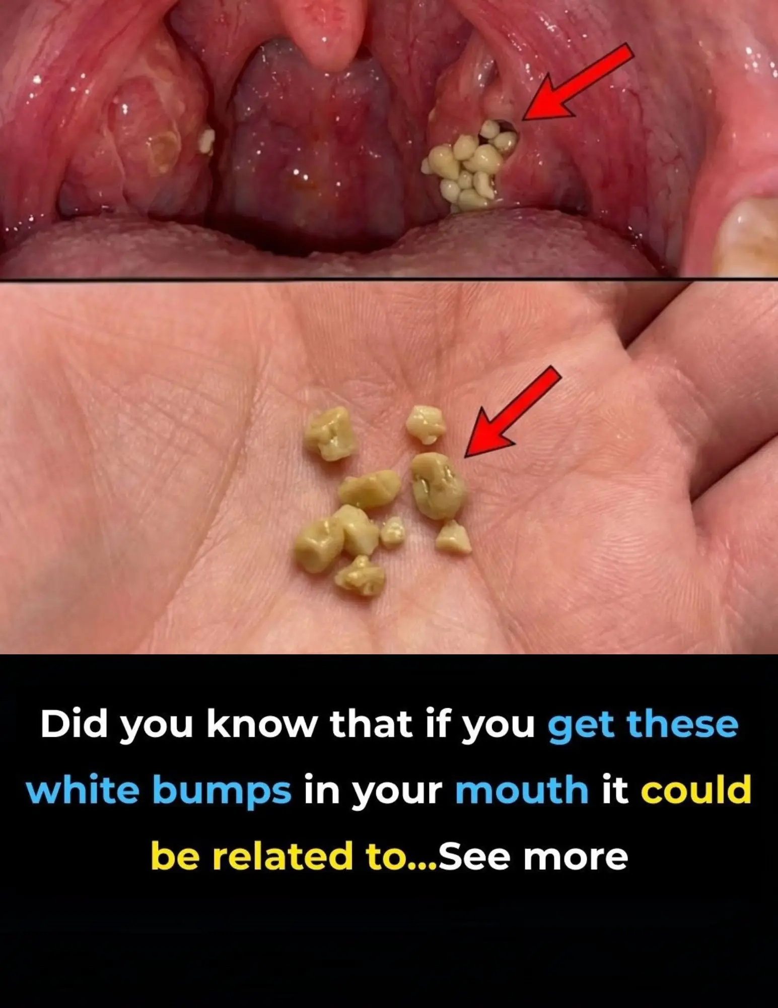 Tonsil Stones: Discover what they are, how they appear, and how to get rid of them forever.
