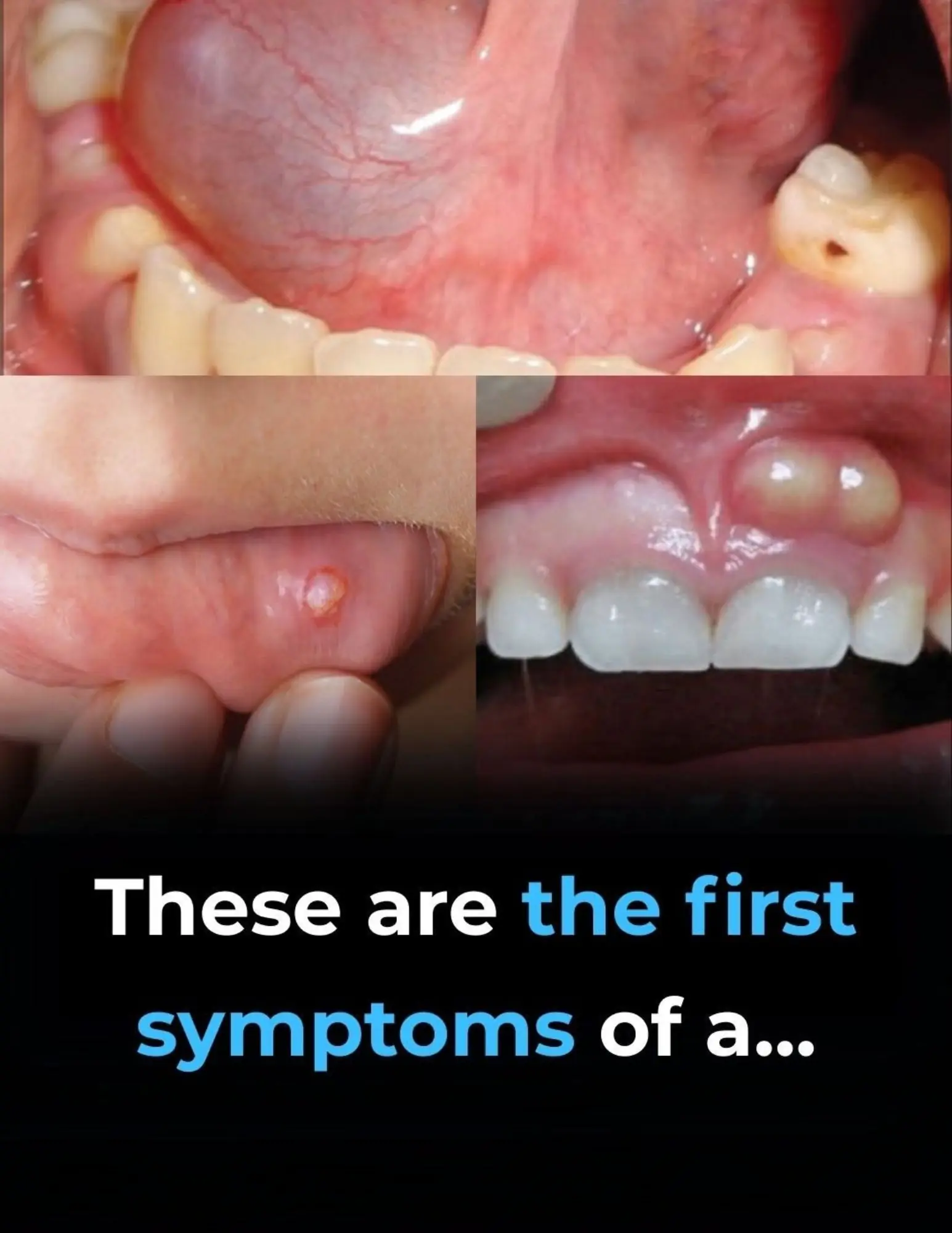 Hidden Dangers in Your Mouth: Early Signs of Oral Cancer