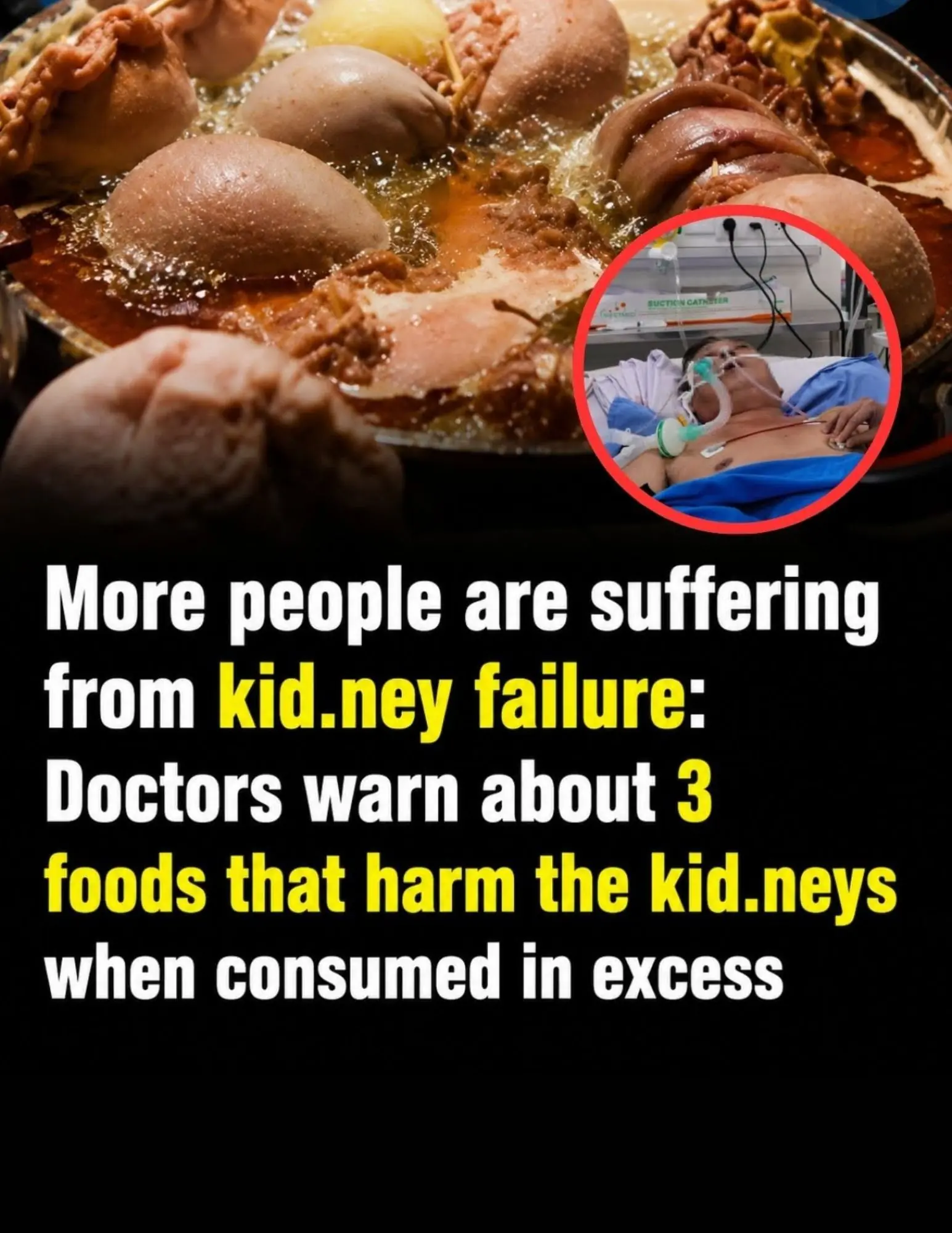 Doctors Warn: 3 Common Foods That May Put Extra Stress on Your Kidneys When Eaten Too Often