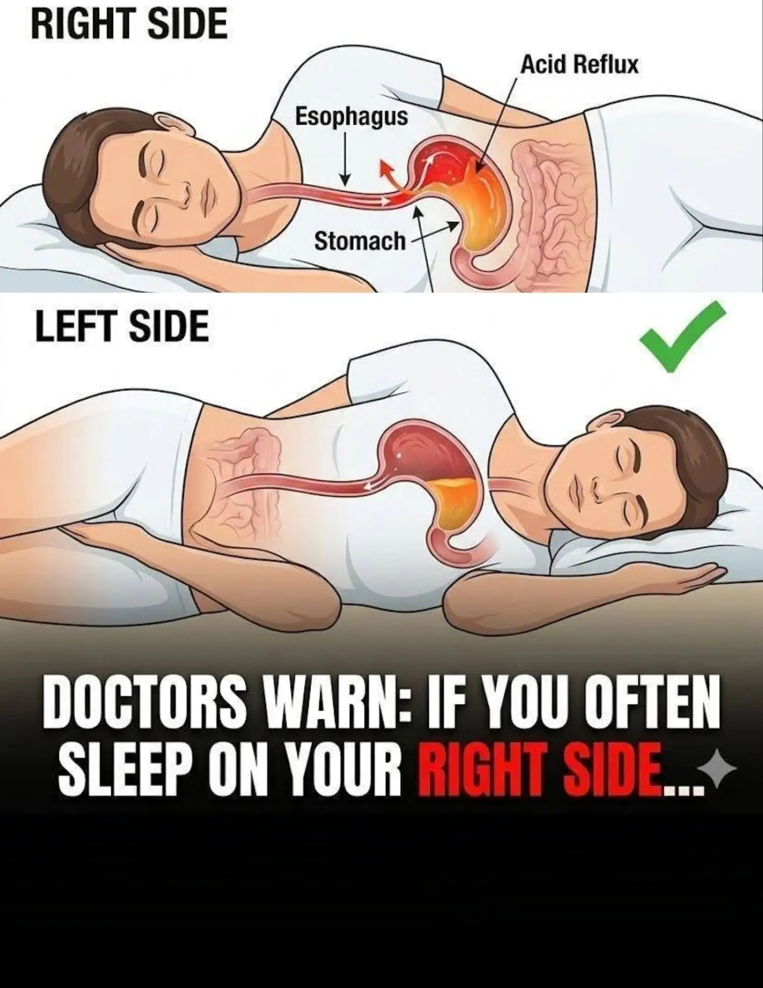 Doctors Warn: Your Sleeping Position May Affect Acid Reflux Symptoms