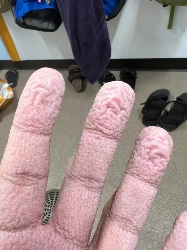 Wrinkled Fingers After Water Exposure: What Your Skin May Be Telling You