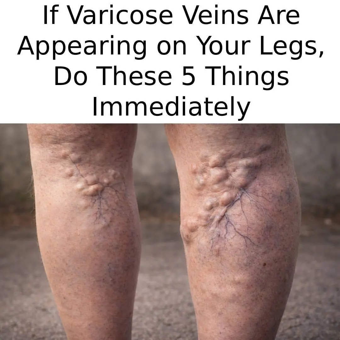 14 Tips to Improve Varicose Veins Naturally + The Best Essential Oils for Varicose Veins