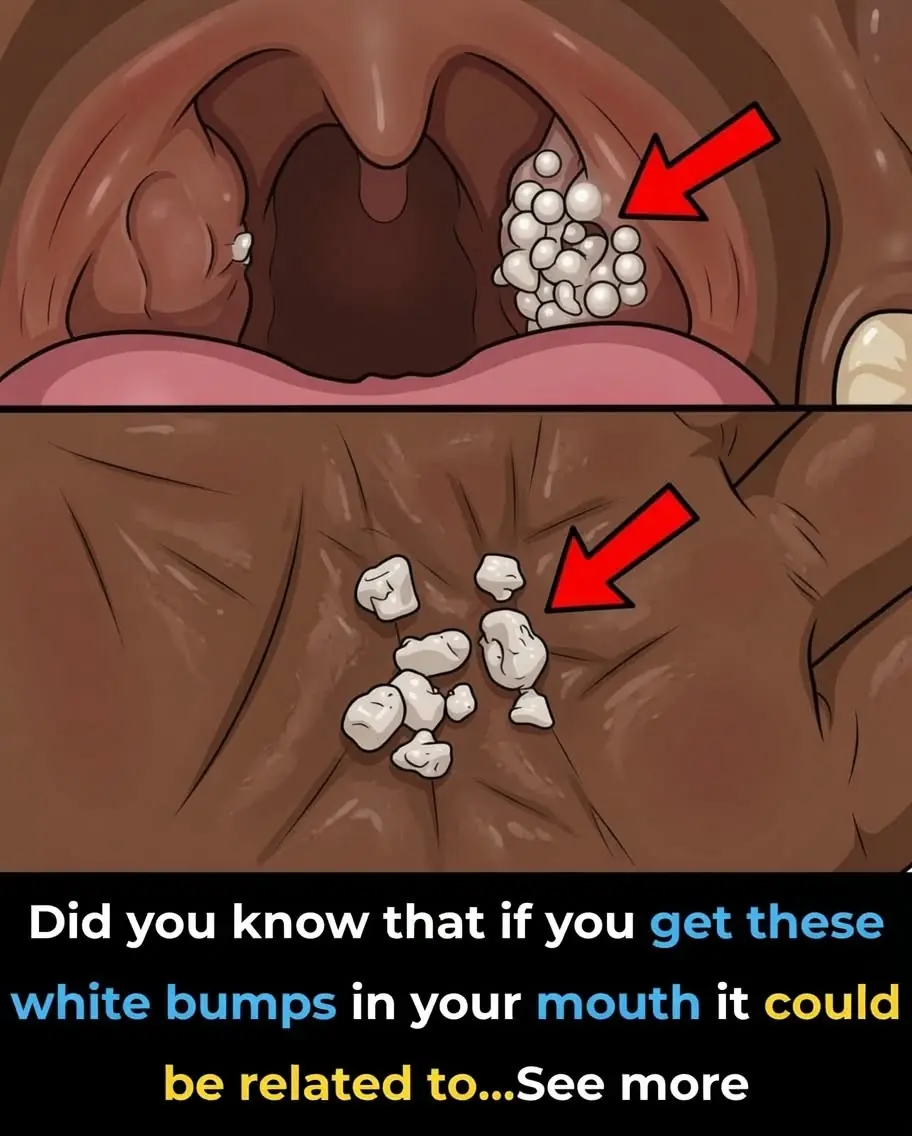 White Bumps on Your Tonsils: What They Mean and When You Should Be Concerned