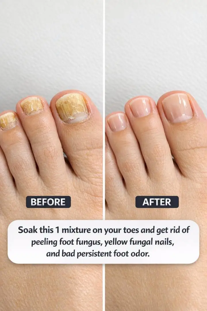 Soak this 1 mixture on your toes and get rid of peeling foot fungus, yellow fungal nails, and bad persistent foot odor.