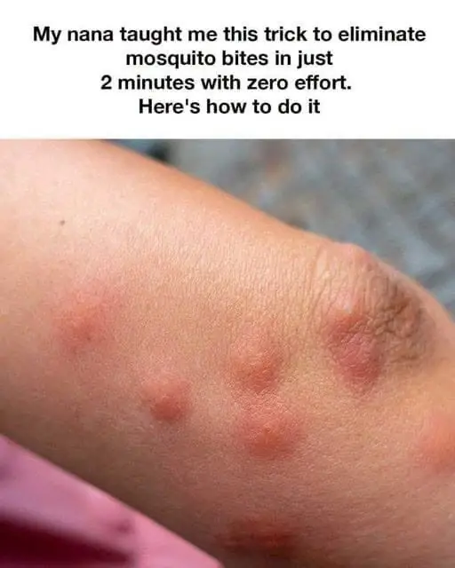 Trick To Stop Mosquito Bite From Itching