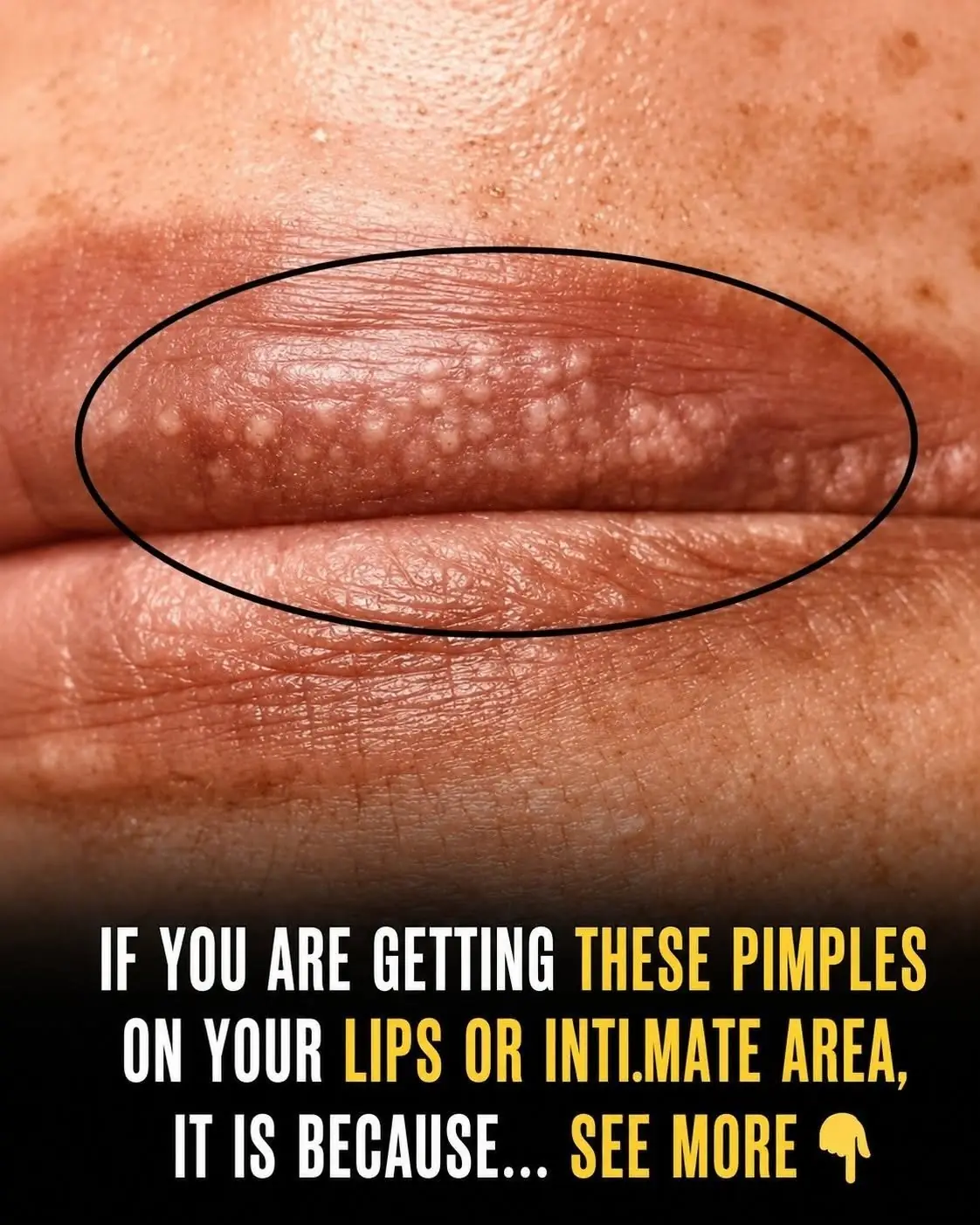 If You Are Getting White Pimples on Your Lips or Intimate Area, Here's What They Could Mean