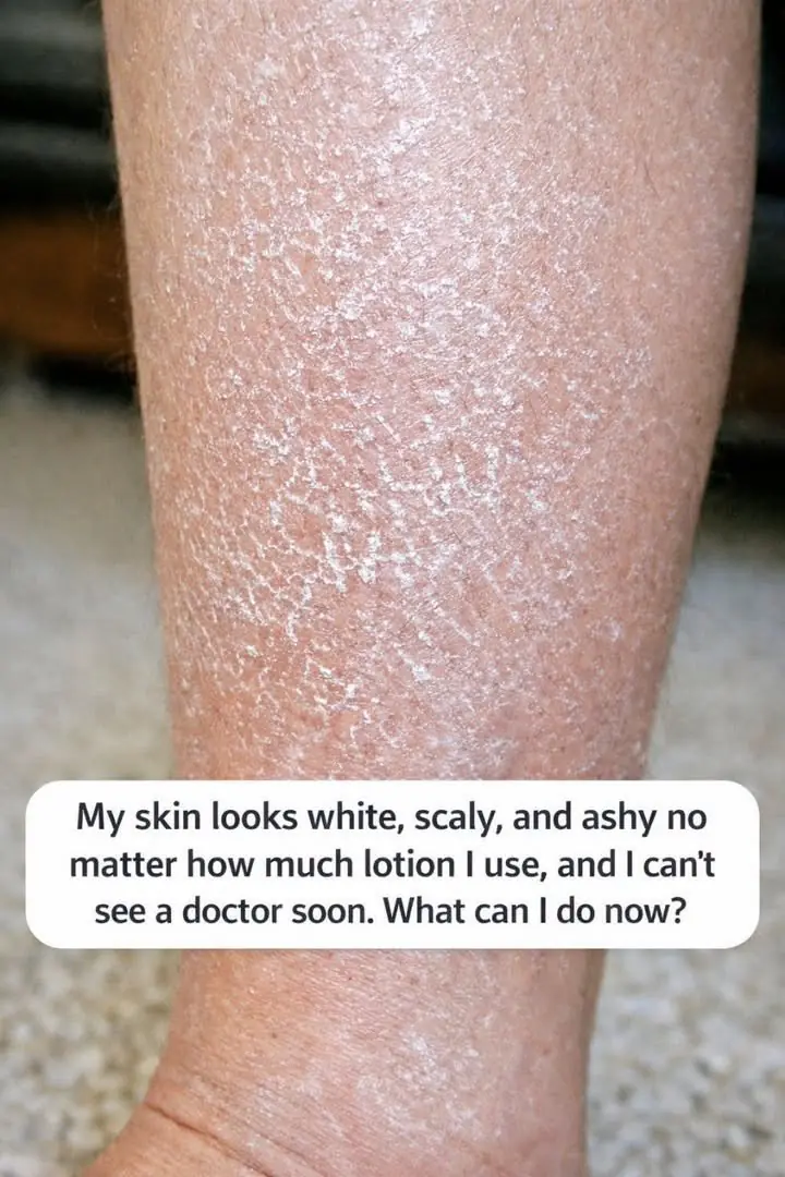 My skin looks white, scaly, and ashy no matter how much lotion I use, and I can’t see a doctor soon. What can I do now?