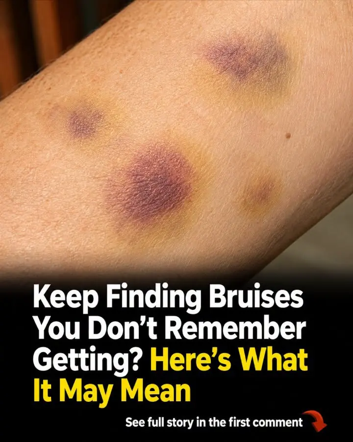 Unexplained Bruising on Your Body: Causes and Treatments