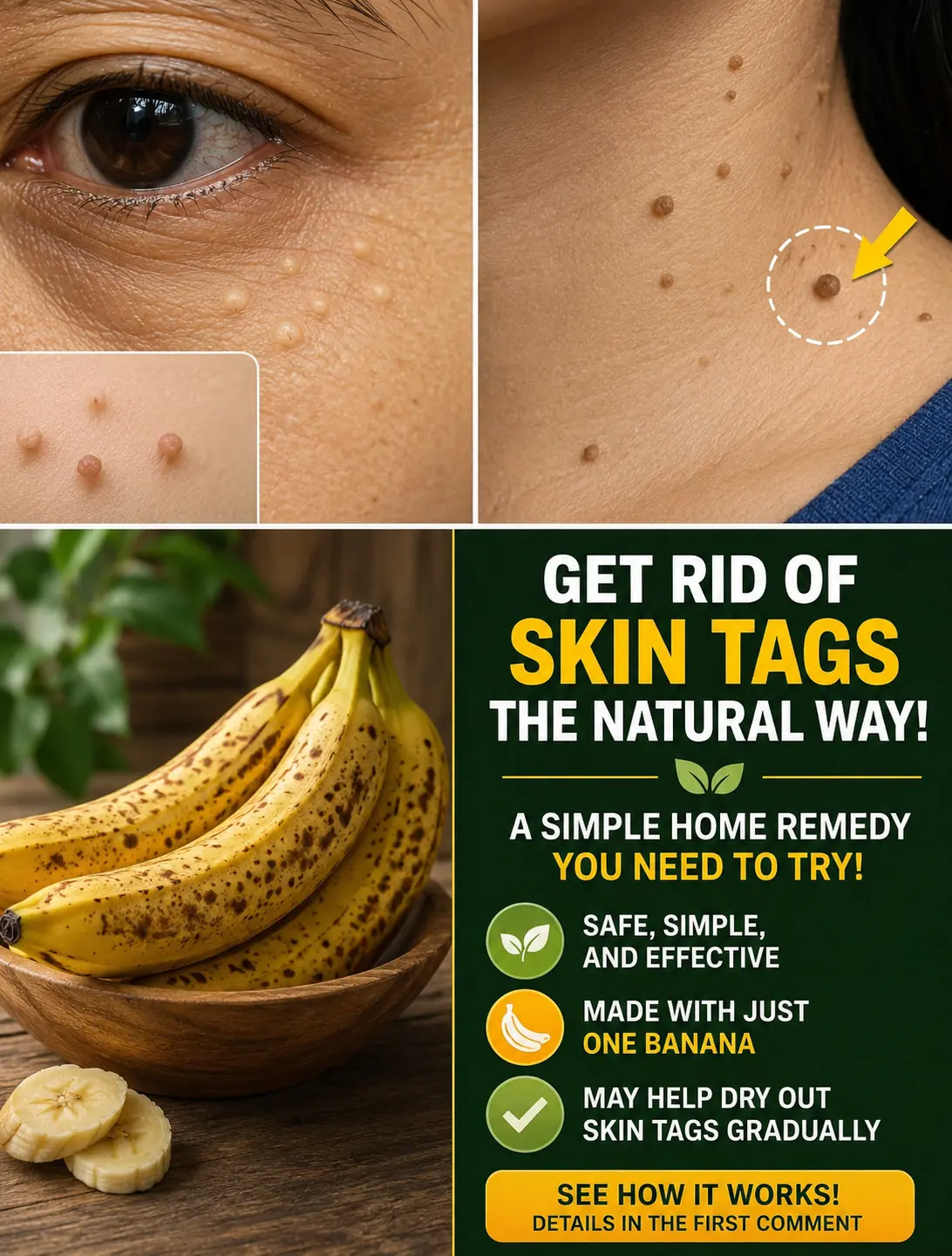 Banana Peel and Natural Ingredients for Wart Care: Gentle Home Remedies You Should Know