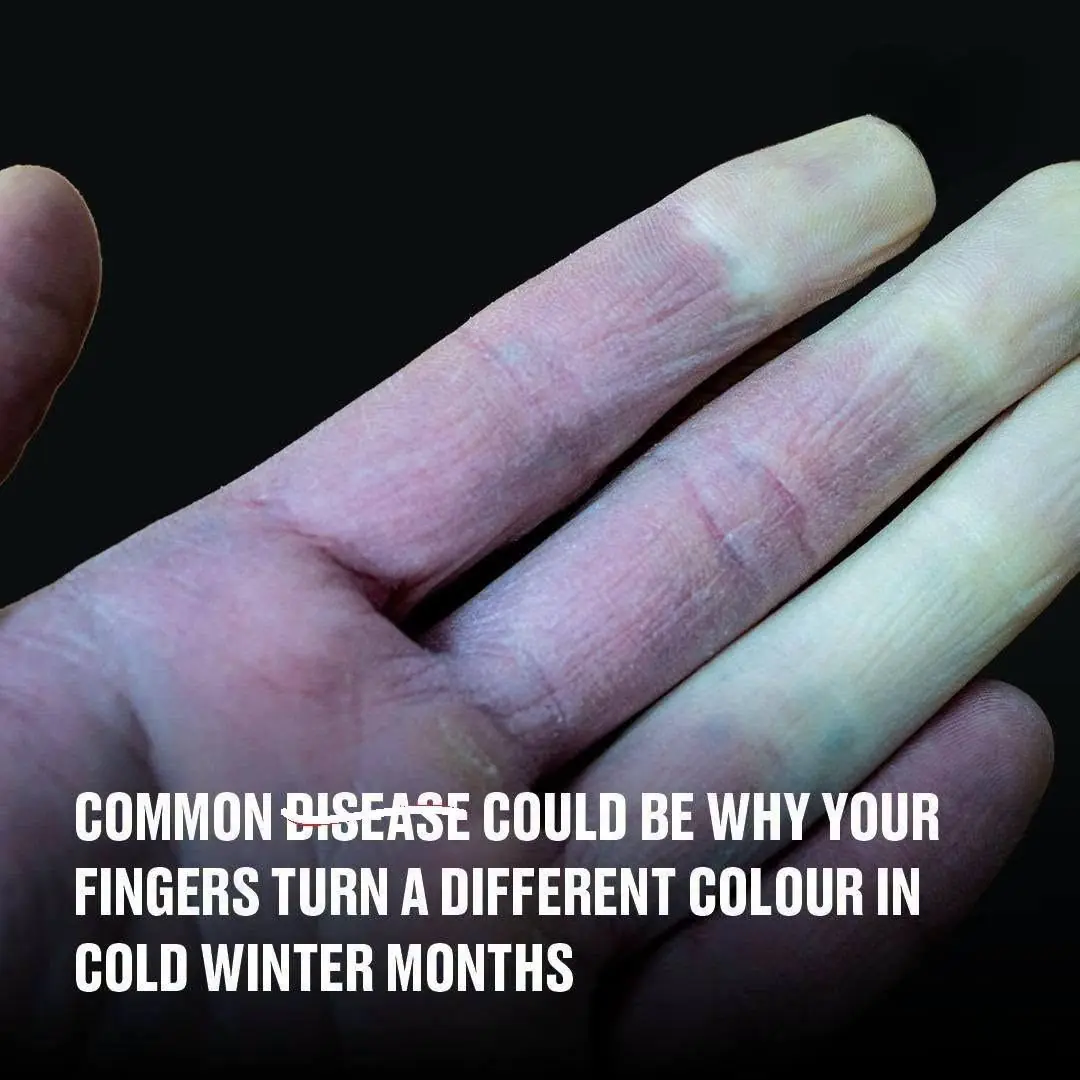 What It Means If Your Fingers Turn White When It’s Cold