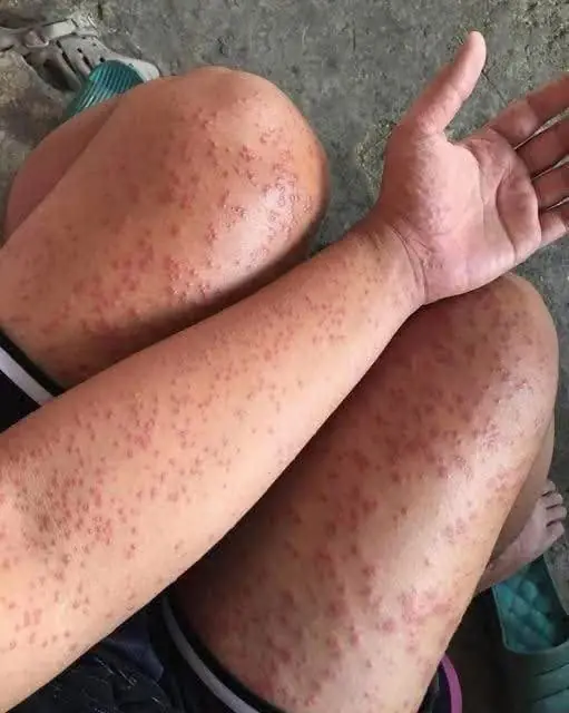 Skin Rash With Breathing Trouble? It Could Be a Life-Threatening Allergic Reaction