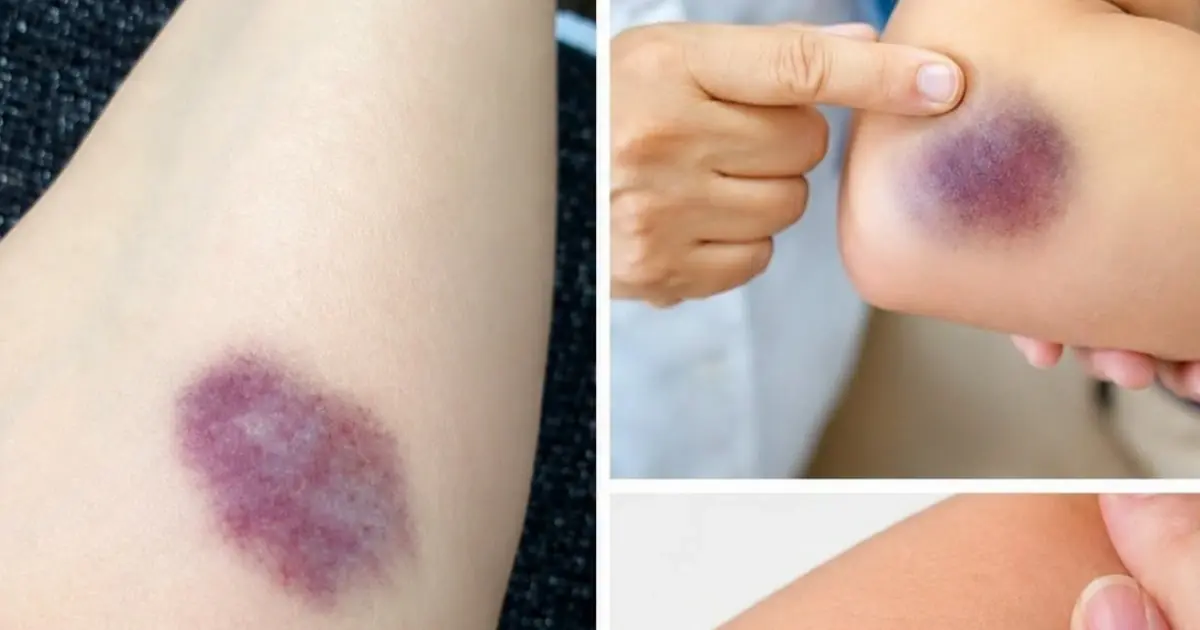 BE CAREFUL, if you get these bruises on your body, it means you have Ca…
