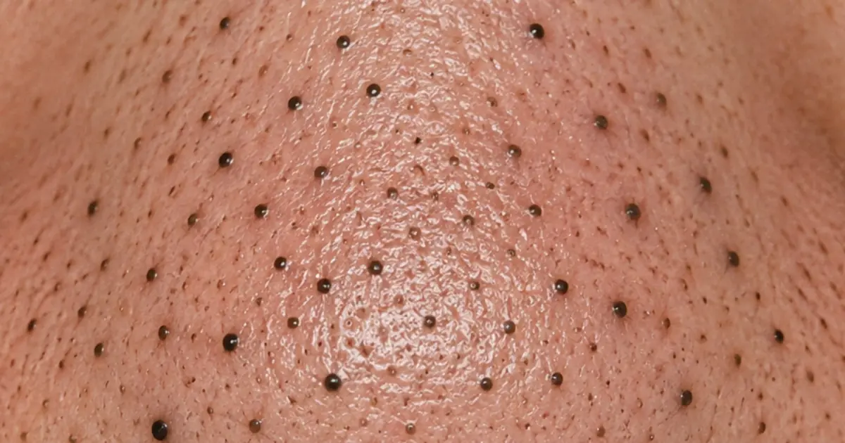 Rub this 1 mixture on your nose and get rid of deep dark blackheads, enlarged pores, and greasy buildup for glowing skin.