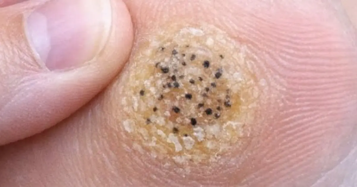 My daughter is limping from this hard rough spot with black dots on her sole. She has a dance recital tomorrow and is crying in pain. Need a fast fix!