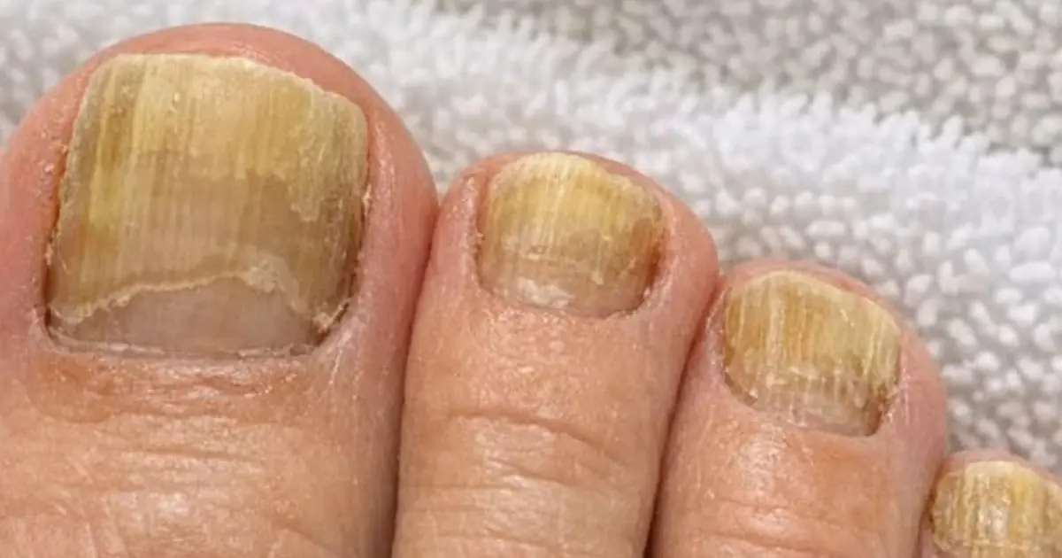 Rub this 1 mixture on your toes and get rid of thick yellow toenails, fungal discoloration, brittle texture
