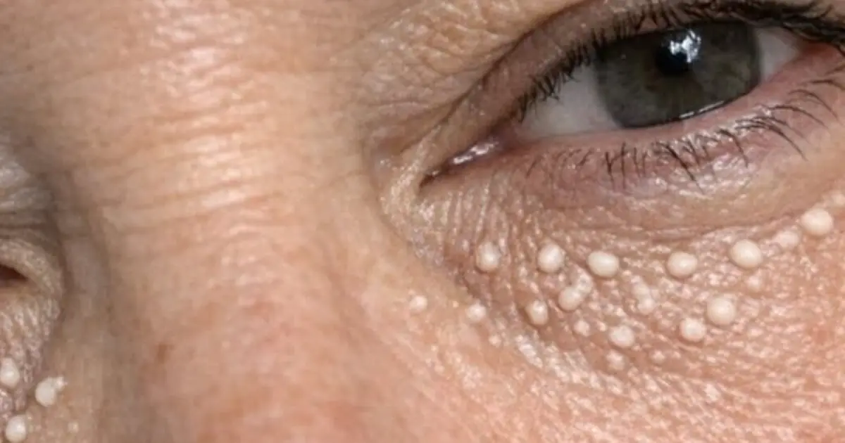 Wipe this 1 method on your face and get rid of hard under eye milia, tiny white bumps, and trapped keratin spots