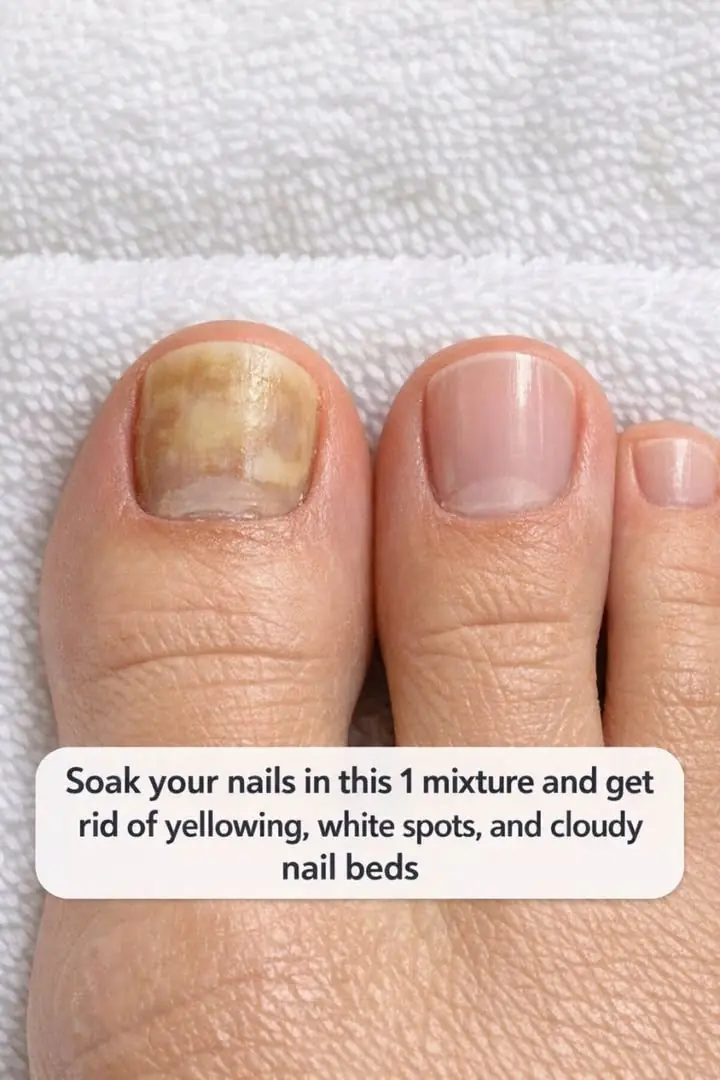 Soak your nails in this 1 mixture and get rid of yellowing, white spots, and cloudy nail beds